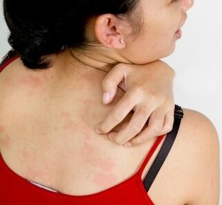 granulomi sul corpo - sintomi della presenza di parassiti