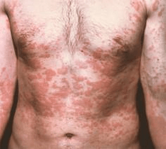 la pelle problematica è un sintomo della presenza di parassiti