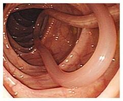 parassiti nel corpo umano
