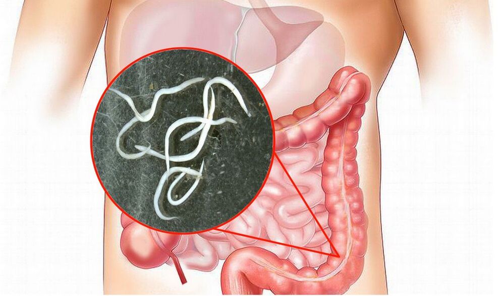 vermi nell'intestino