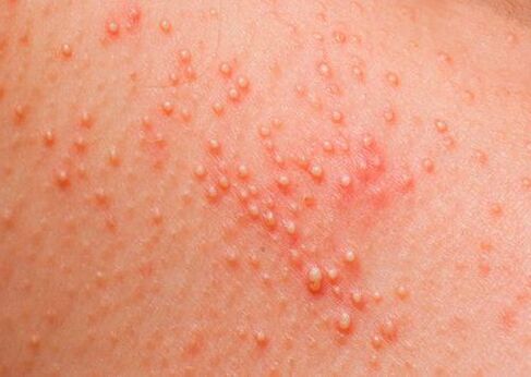 Se il corpo è affetto da parassiti, compare un'allergia cutanea