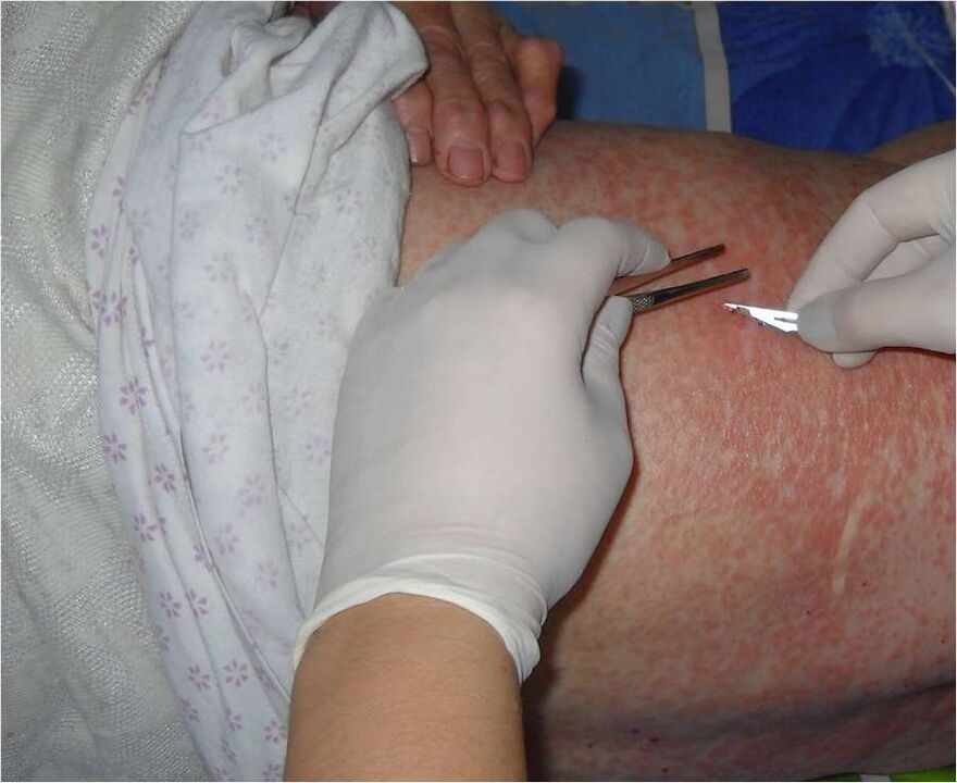 Raschiatura dell'area interessata per rilevare i parassiti sotto la pelle
