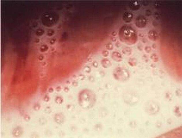 scarico di bolle con parassiti protozoi